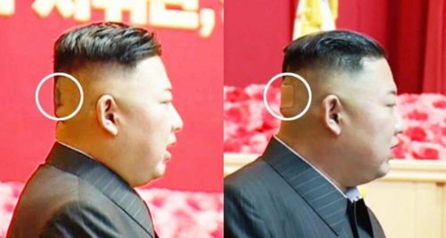 Τι συμβαίνει με την υγεία του Kim; Το πράσινο σημάδι στο κεφάλι - Οργιάζουν οι φήμες