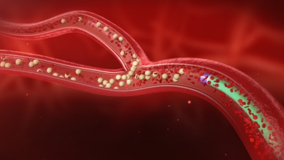 Ο Ραδιοεμβολισμός αποτελεί μια νέα θεραπευτική αντιμετώπιση του καρκίνου του Ήπατος