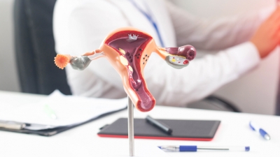 Ινομυώματα μήτρας: Οι ανοικτές επεμβάσεις δεν είναι μονόδρομος