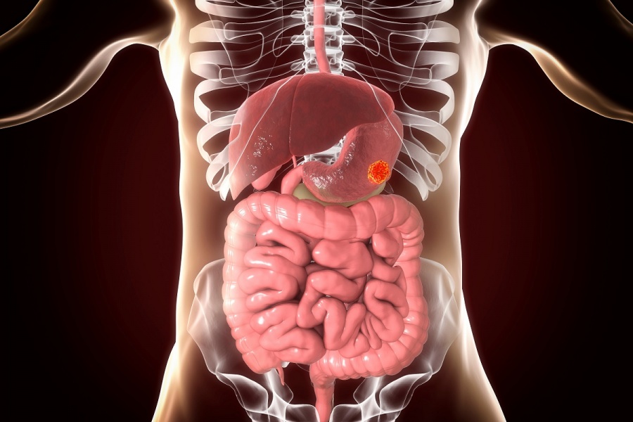 Πρόληψη καρκίνου με ενδοσκόπηση