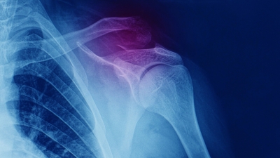 Οστεοπορωτικά κατάγματα: Η «μάστιγα» του 21ου αιώνα