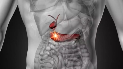 Καρκίνος Παγκρέατος: Ελπιδοφόρα μηνύματα για το 1/3 των ανεγχείρητων καρκίνων