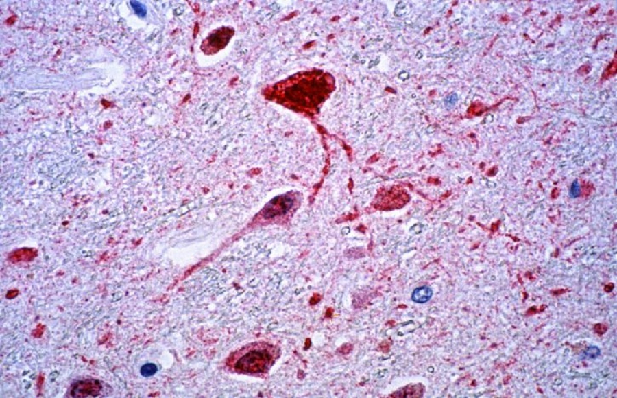 Σοκάρει ο νέος θανατηφόρος ιός Nipah - Δεν υπάρχει εμβόλιο ούτε θεραπεία - Τα συμπτώματα