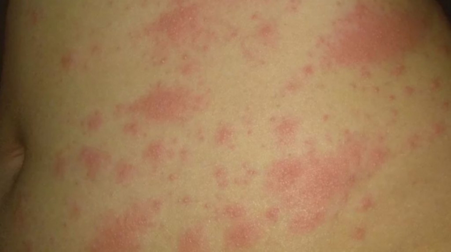 Έτσι «μοιάζει» η μετάλλαξη Omicron: Αυτά είναι τα δερματικά συμπτώματα που προκαλεί