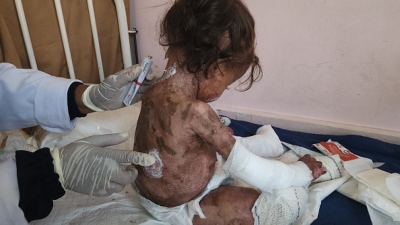 Σαρώνουν τα μωρά οι αρρώστιες - Η κατεστραμμένη Γάζα αντιμετωπίζει τρομερή αύξηση σπάνιων παιδικών λοιμώξεων