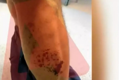 Μυστήριοι τραυματισμοί στα Τέμπη: «Δεν καήκαμε - Δεν καταλάβαμε τίποτε» λένε οι πυροσβέστες για τα χημικά εγκαύματα