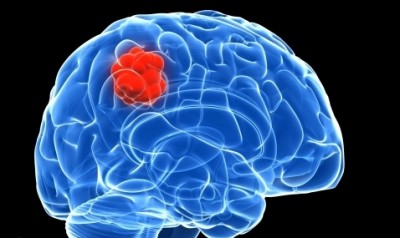 Κακοήθεις όγκοι εγκεφάλου: Όταν «λάμπουν» έχουν διπλάσια πιθανότητα ολικής αφαίρεσης και καλύτερη πρόγνωση