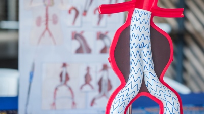 Ανεύρυσμα κοιλιακής αορτής: Παράγοντες κινδύνου  και θεραπεία