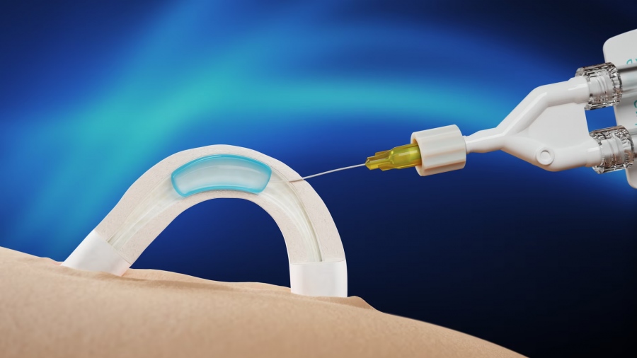 Ανδρικό αντισυλληπτικό εμφύτευμα διαρκεί τουλάχιστον 2 χρόνια - Τι έδειξαν οι εργαστηριακές δοκιμές, πώς λειτουργεί