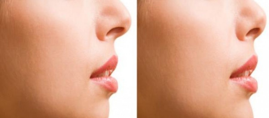 Ρινοπλαστική - Μύθοι και πραγματικότητα