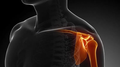 Εξάρθρημα ώμου: H σημασία της πρώτης αντιμετώπισης