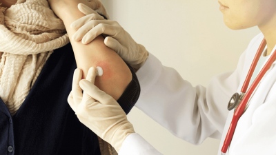 Ψωρίαση - Όλα όσα πρέπει να γνωρίζετε